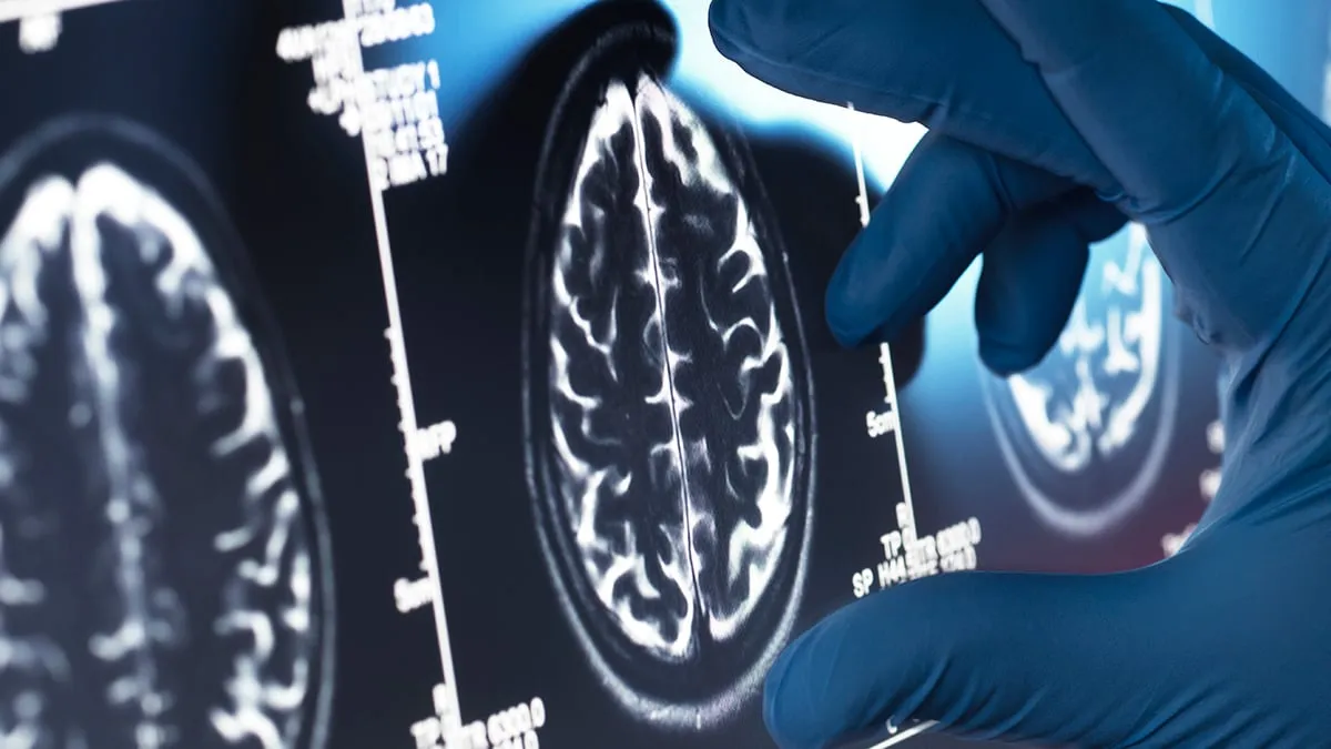 Alzheimer'da köklü değişim: Tehlike aslında beyin dışından geliyor